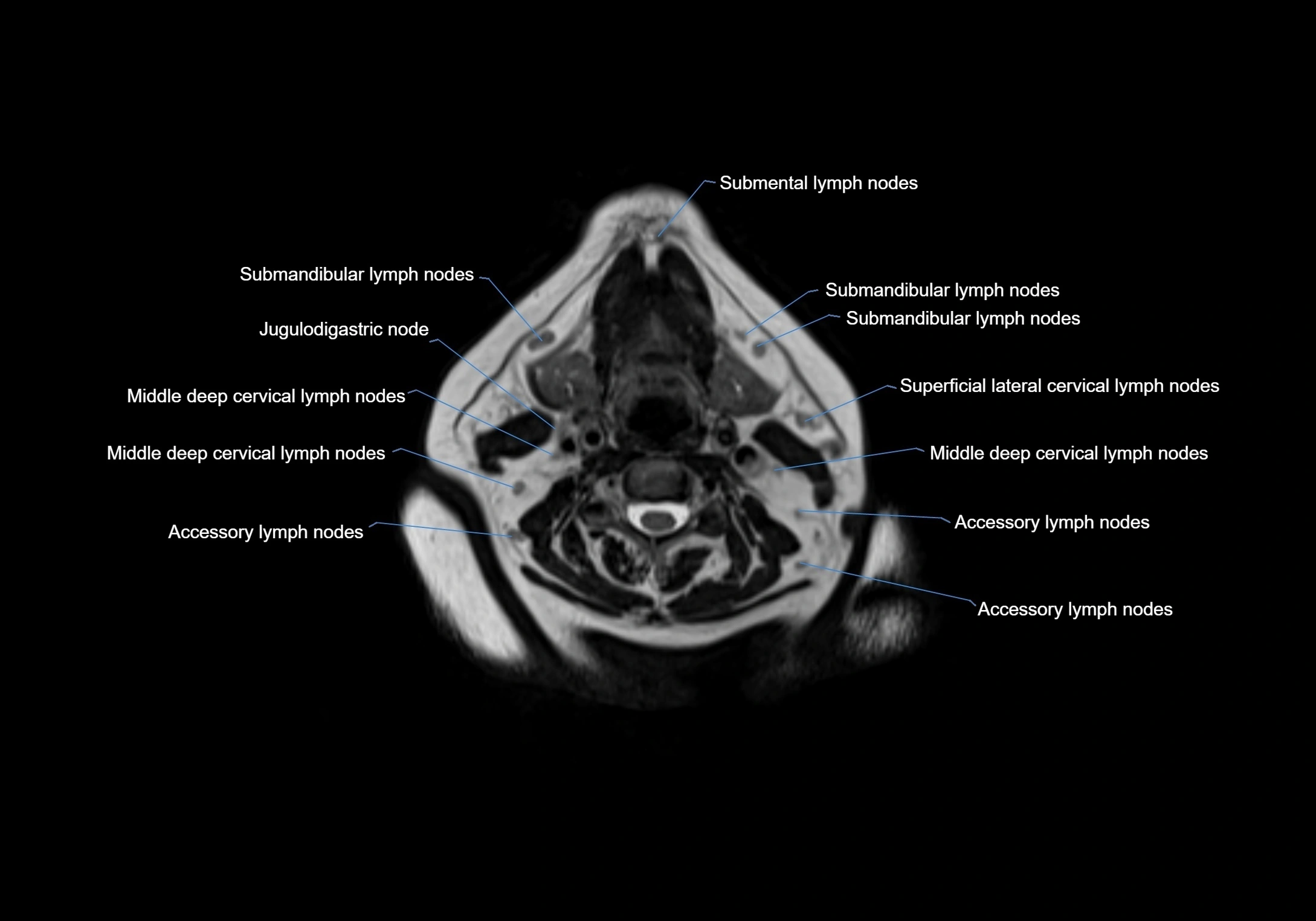 Neck axial  lymph node cross sectional MRI anatomy 3T MRI  image-img-00001-00054.webp